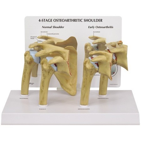 GPI ANATOMICAL Anatomical Model - 4-Stage Shoulder - Osteoarthritis 1800